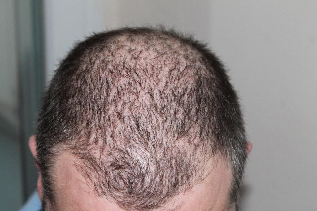 Safety during hair transplantation: what should be considered